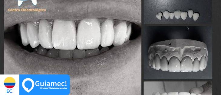 diseño de sonrisa, blanqueamiento dental, ortodoncia en Guayaquil