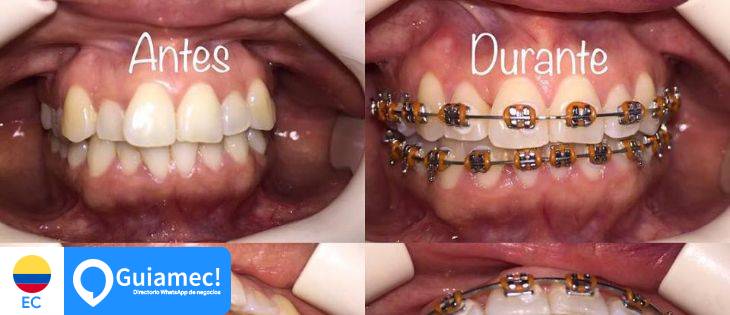 ortodoncia, salud oral, limpieza bucal  en Guayaquil
