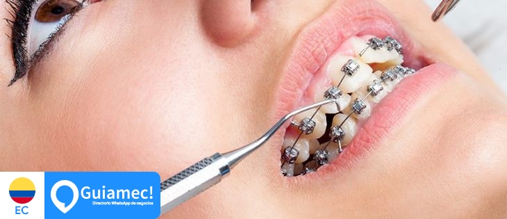 ortodoncia, brackest, diseños de sonrisa,  en Guayaquil