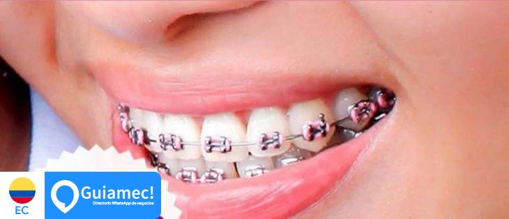 ortodoncia, implante dentales, limpieza dental  en Quito