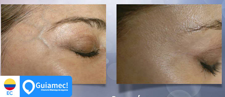 limpieza facial Loja, dermatología Loja en Loja
