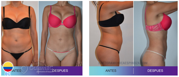 Lipoescultura,Blefaroplastia ,Reducción ,Mentoplastia,Rinoplastia en Guayaquil